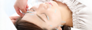 美容鍼の施術を受けている女性