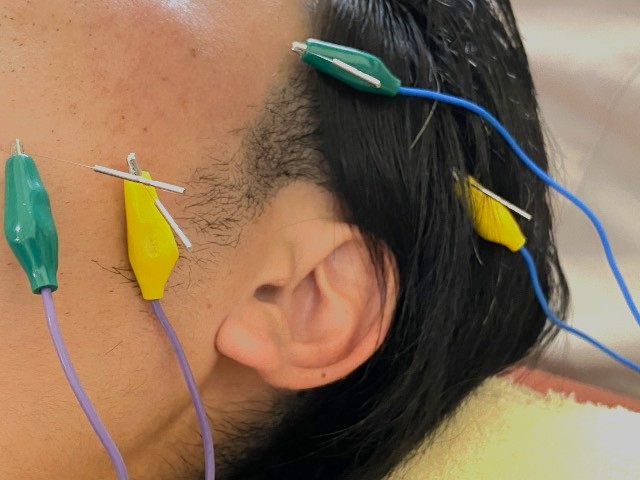 美容鍼の施術を受けている男性の横顔