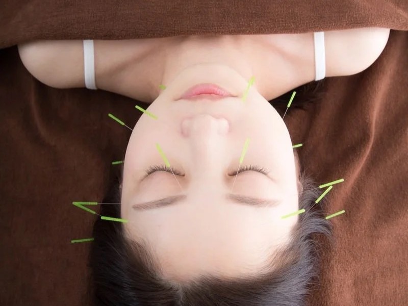 美容鍼の施術を受けている女性
